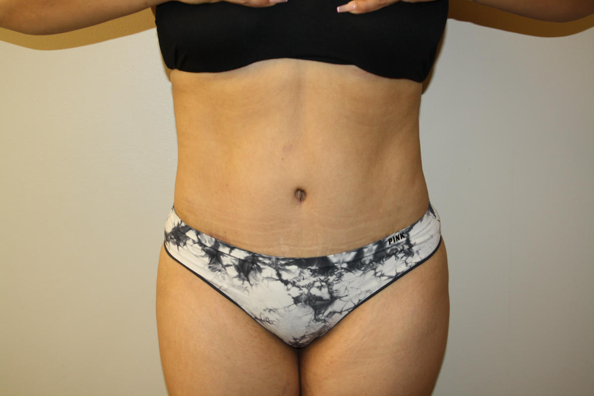 Tummy Tuck Before & After Patient #2998