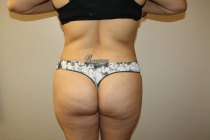 Tummy Tuck Before & After Patient #2998