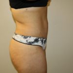 Tummy Tuck Before & After Patient #2998