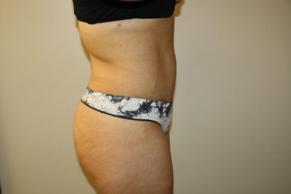 Tummy Tuck Before & After Patient #2998