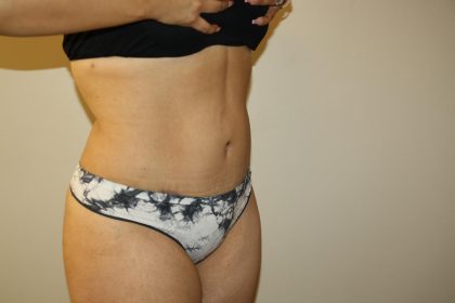 Tummy Tuck Before & After Patient #2998