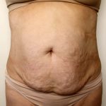 Tummy Tuck Before & After Patient #2956