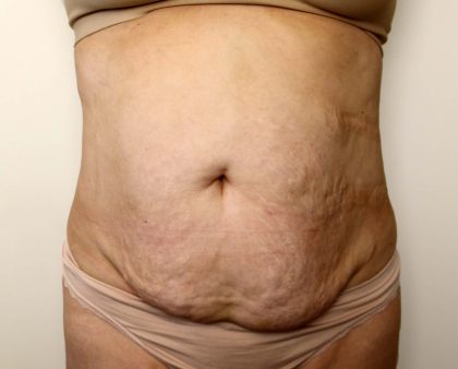 Tummy Tuck Before & After Patient #2956