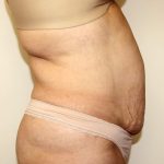 Tummy Tuck Before & After Patient #2956