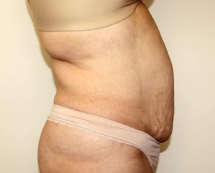 Tummy Tuck Before & After Patient #2956