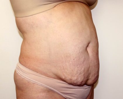 Tummy Tuck Before & After Patient #2956