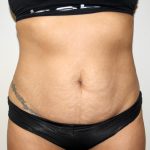 Tummy Tuck Before & After Patient #3034