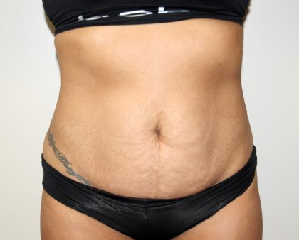 Tummy Tuck Before & After Patient #3034