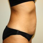 Tummy Tuck Before & After Patient #3034