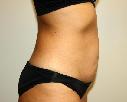 Tummy Tuck Before & After Patient #3034