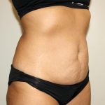 Tummy Tuck Before & After Patient #3034