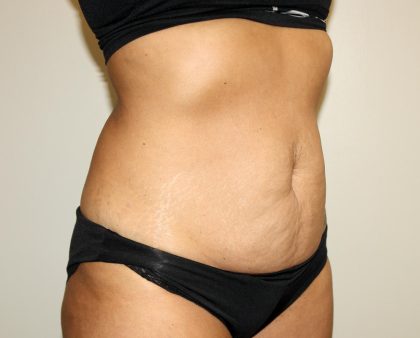 Tummy Tuck Before & After Patient #3034