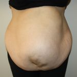 Tummy Tuck Before & After Patient #2949