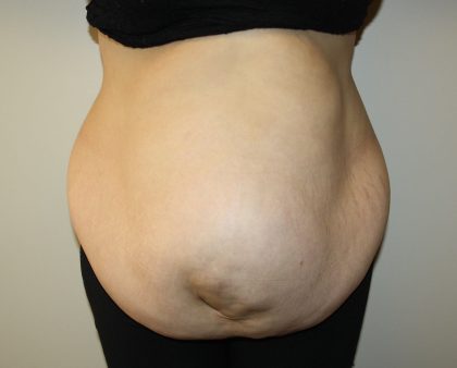 Tummy Tuck Before & After Patient #2949