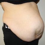 Tummy Tuck Before & After Patient #2949