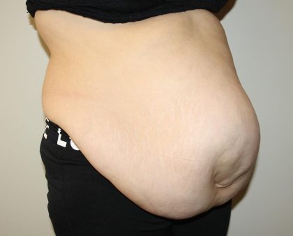 Tummy Tuck Before & After Patient #2949