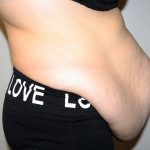 Tummy Tuck Before & After Patient #2949