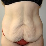 Tummy Tuck Before & After Patient #3027