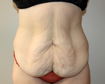 Tummy Tuck Before & After Patient #3027