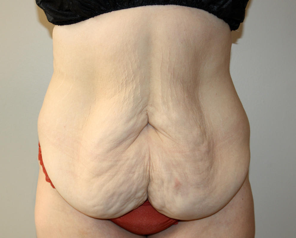 Major Weight Loss Tummy Tuck Before & After Patient #3027