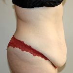 Tummy Tuck Before & After Patient #3027