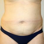 Tummy Tuck Before & After Patient #2864