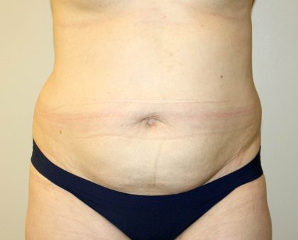 Tummy Tuck Before & After Patient #2864