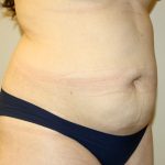 Tummy Tuck Before & After Patient #2864