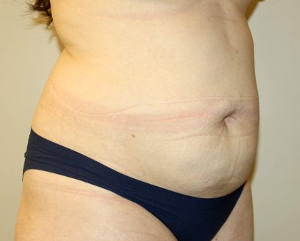 Tummy Tuck Before & After Patient #2864
