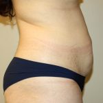 Tummy Tuck Before & After Patient #2864