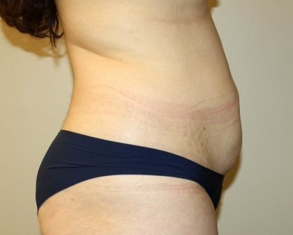 Tummy Tuck Before & After Patient #2864