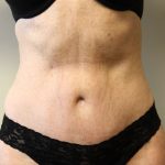 Tummy Tuck Before & After Patient #2899