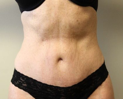 Tummy Tuck Before & After Patient #2899