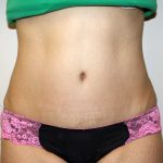 Tummy Tuck Before & After Patient #2935