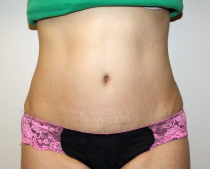 Tummy Tuck Before & After Patient #2935