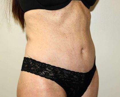 Tummy Tuck Before & After Patient #2899
