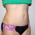 Tummy Tuck Before & After Patient #2935