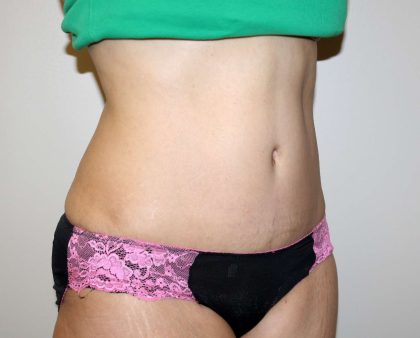 Tummy Tuck Before & After Patient #2935