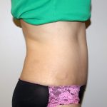 Tummy Tuck Before & After Patient #2935