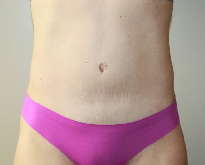 Tummy Tuck Before & After Patient #2892