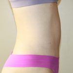 Tummy Tuck Before & After Patient #2892