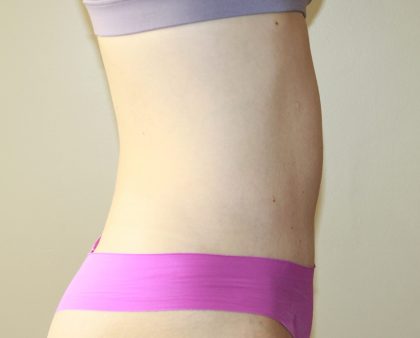 Tummy Tuck Before & After Patient #2892