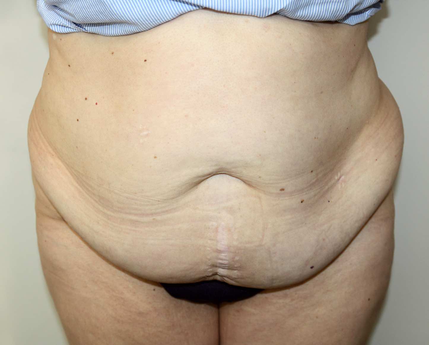 Major Weight Loss Tummy Tuck Before & After Patient #2970