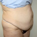 Tummy Tuck Before & After Patient #2970