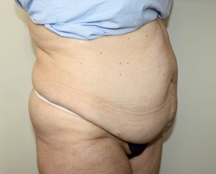 Tummy Tuck Before & After Patient #2970