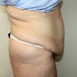 Tummy Tuck Before & After Patient #2970