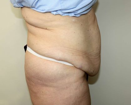 Tummy Tuck Before & After Patient #2970