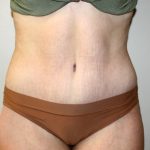 Tummy Tuck Before & After Patient #3027