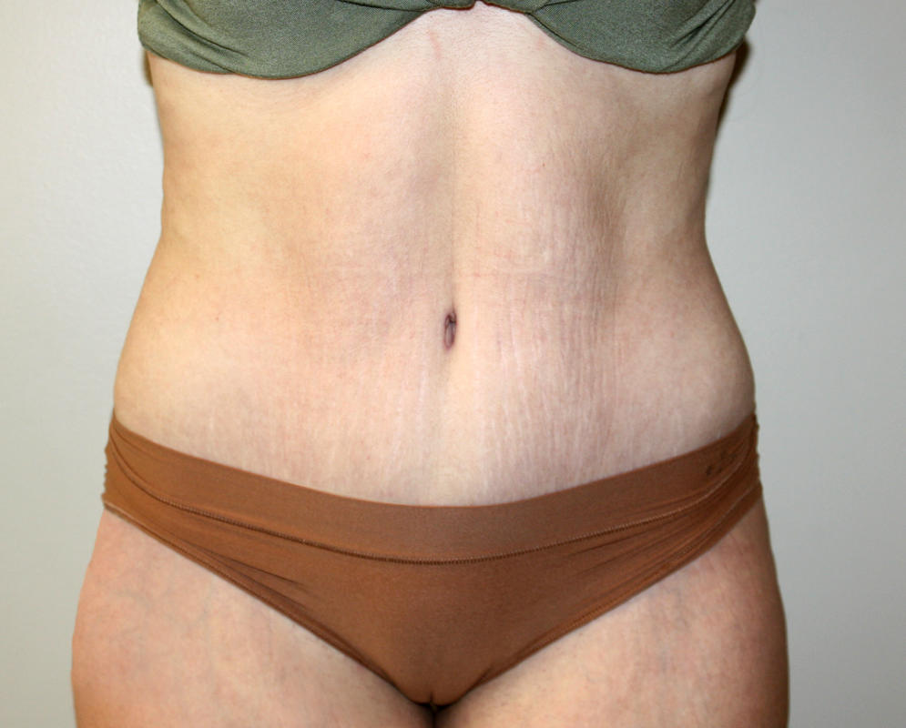 Major Weight Loss Tummy Tuck Before & After Patient #3027