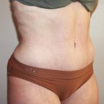 Tummy Tuck Before & After Patient #3027